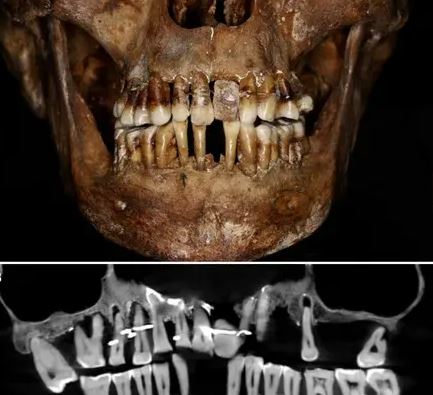 بعد 400 عام على وفاتها.. أسنانها لا تزال معلّقة ولم تسقط!