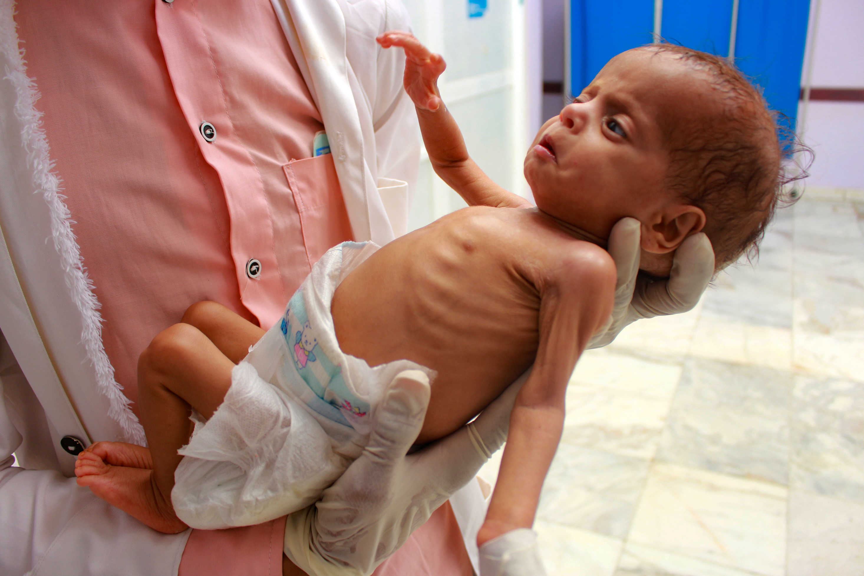 طفل يموت كل 10 دقائق .. سوء التغذية يفتك بأطفال اليمن